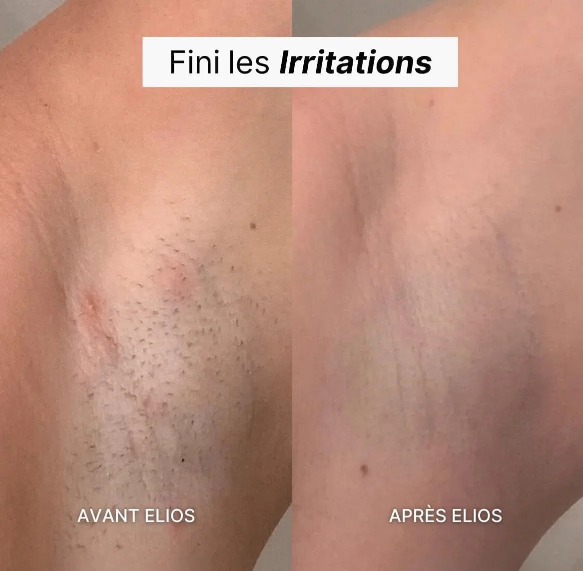 Elios Rasoir Femme, Rasoir Elios Femme 5 en 1, Rasoir Femme, Épilateur Électrique avec Affichage LED et Chargement USB, IPX7 Étanche, pour Bikini, Aisselles