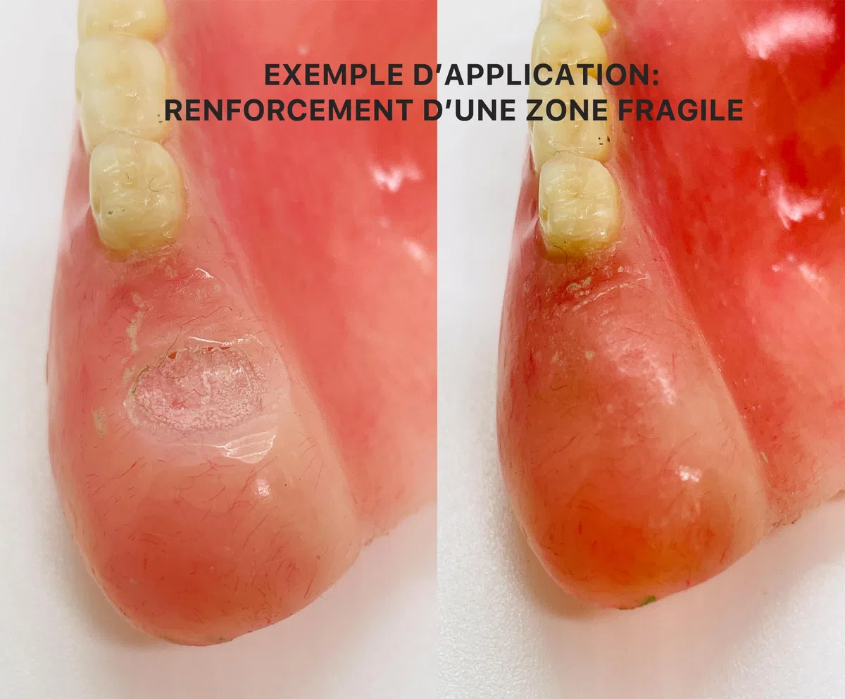 RESINE DENTAIRE ROSE | MEDIDENT |- réparations des prothèse dentaires-dentier cassé-dent détachée
