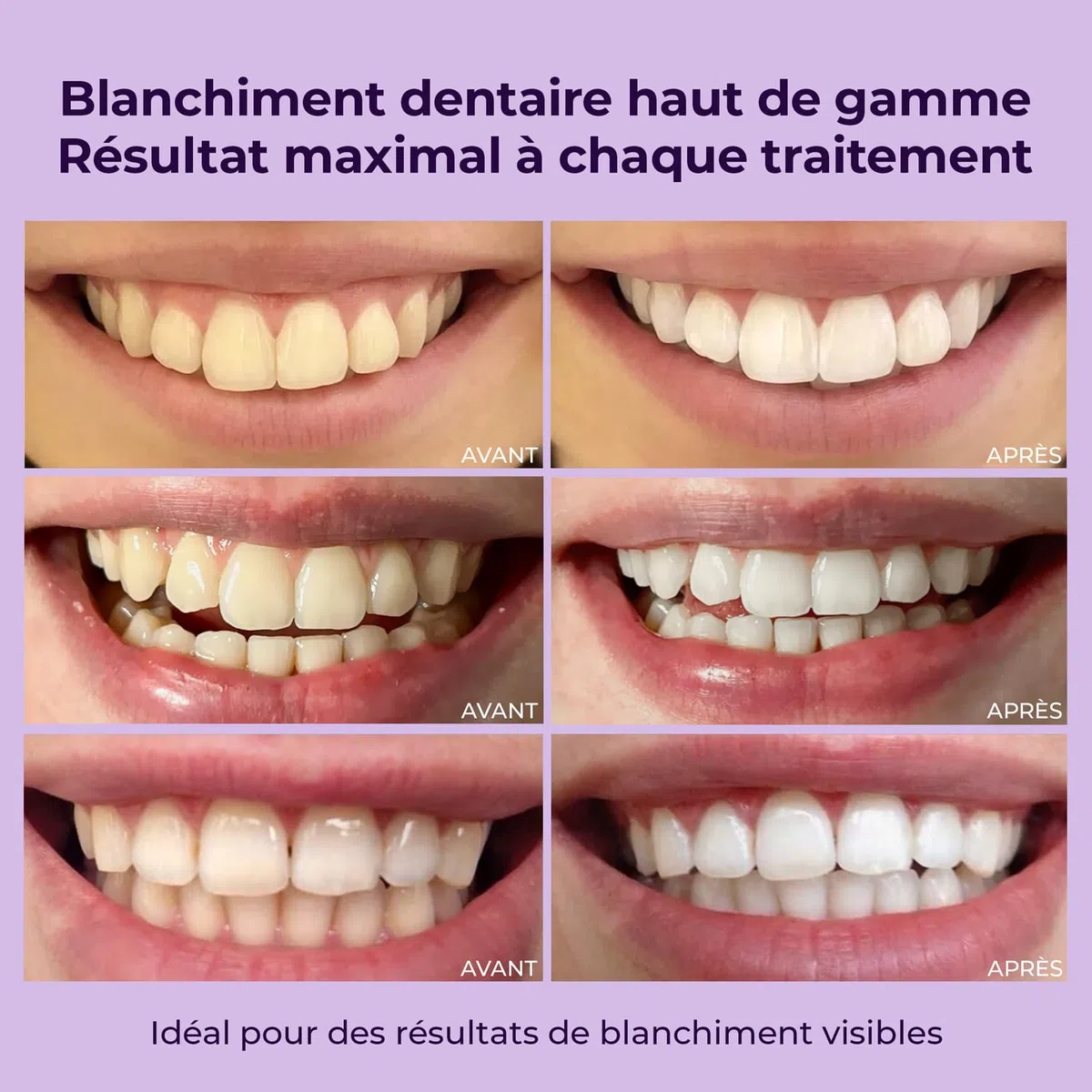 OnlySmile Gel de Blanchiment Dentaire à Domicile (40 ml) – Lauréat du Test 2025, Gel Blanchissant pour Dents Sensibles, Résultats Visibles en 5 Jours, Compatible avec Gouttières et LED