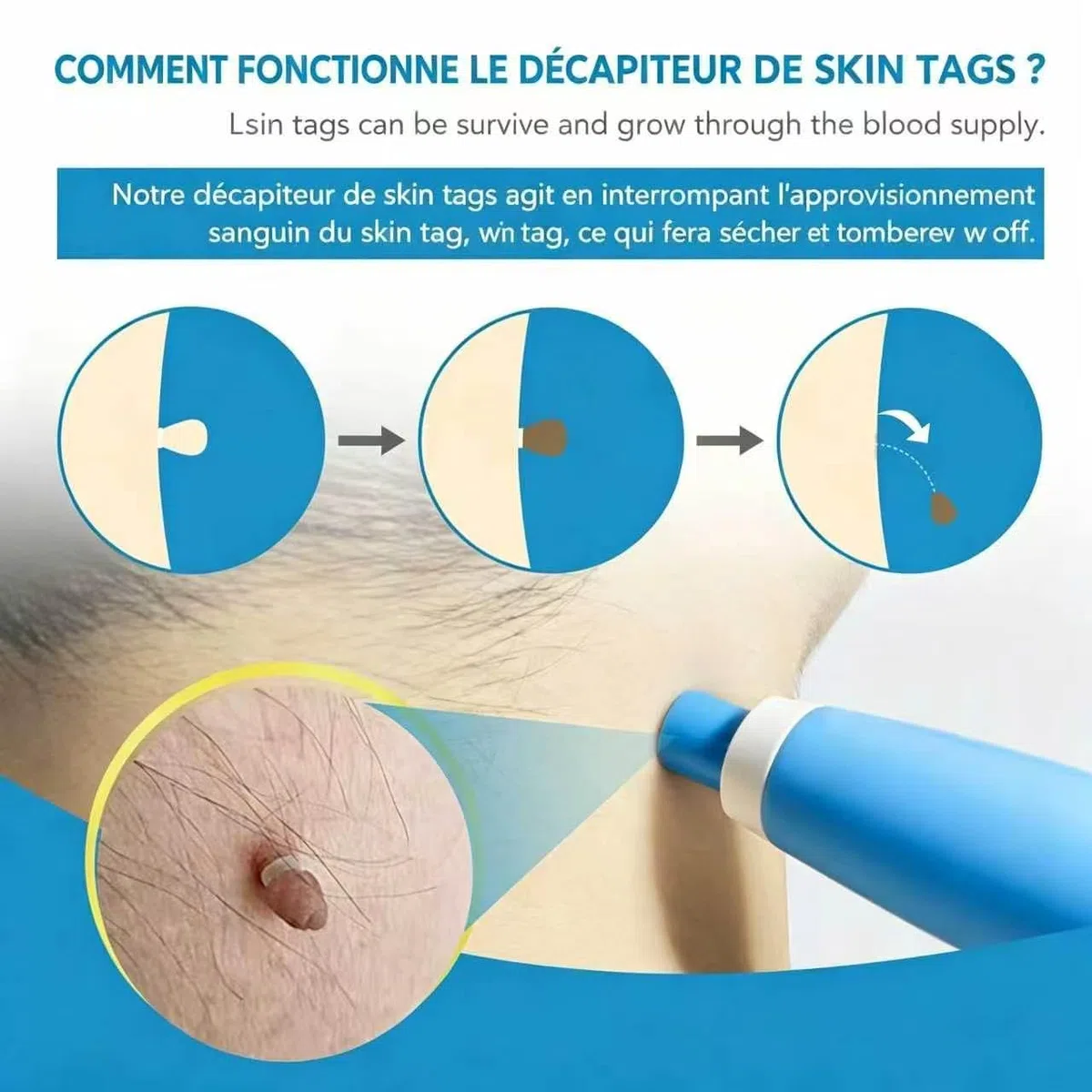 DermaSkin Pro - Adieu les acrochordons, Kit Acrochordon Traitement Efficace, Facile à Utiliser (1 Kit)