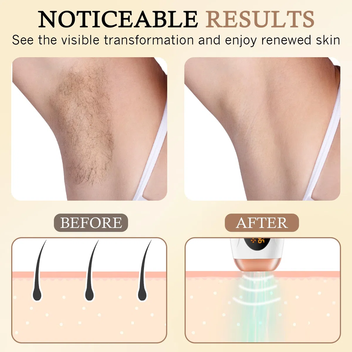 Épilateur Lumière Pulsée avec Refroidissement, 999,999 Flashs, 5 Niveaux d'Énergie, Salon à la Maison, Épilation Laser Définitive et Indolore pour Femme & Homme, Visage, Corps, Maillot, Aisselles