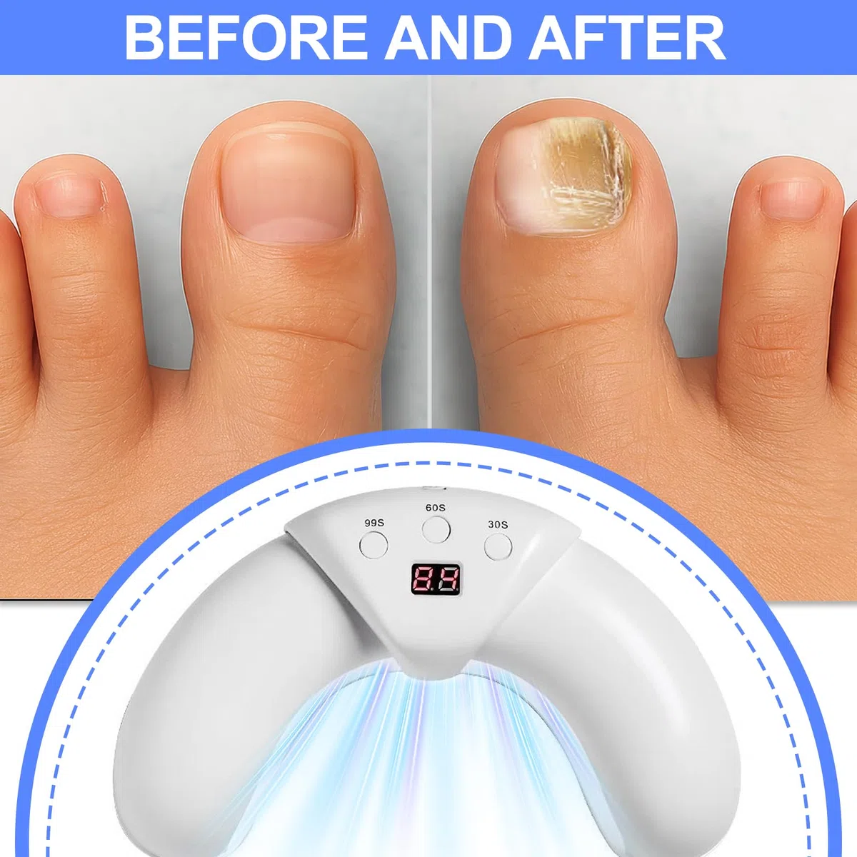 Appareil laser contre les champignons des ongles - Pour plusieurs ongles des mains et des orteils - Pour ongles endommagés et décolorés