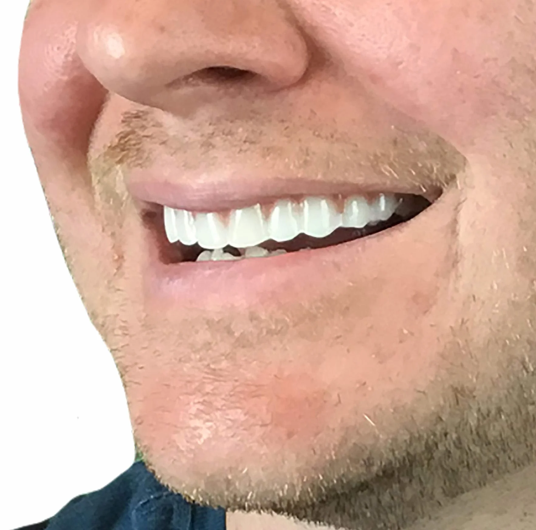 Instant Smile Dents Cosmétiques Comfort Fit Flex Teinte Naturelle Superior Comfort Layer Easy Fit Dentures Taille Unique