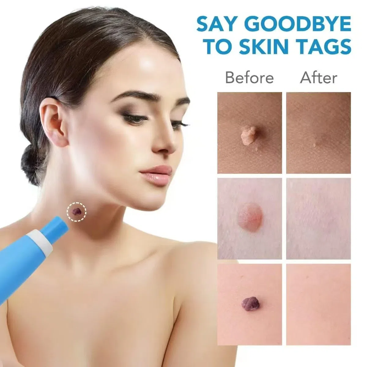 DermaSkin Pro - Adieu les acrochordons, Kit Acrochordon Traitement Efficace, Facile à Utiliser (1 Kit)