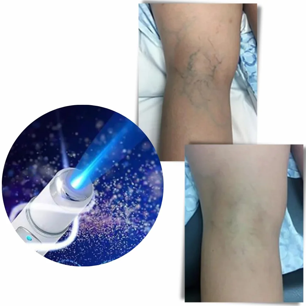 Générique Dispositif De Traitement des Varices Non Invasif, équipement De Traitement des Varices Au Laser, Dispositif Laser pour Varices à Domicile (1x - Single)
