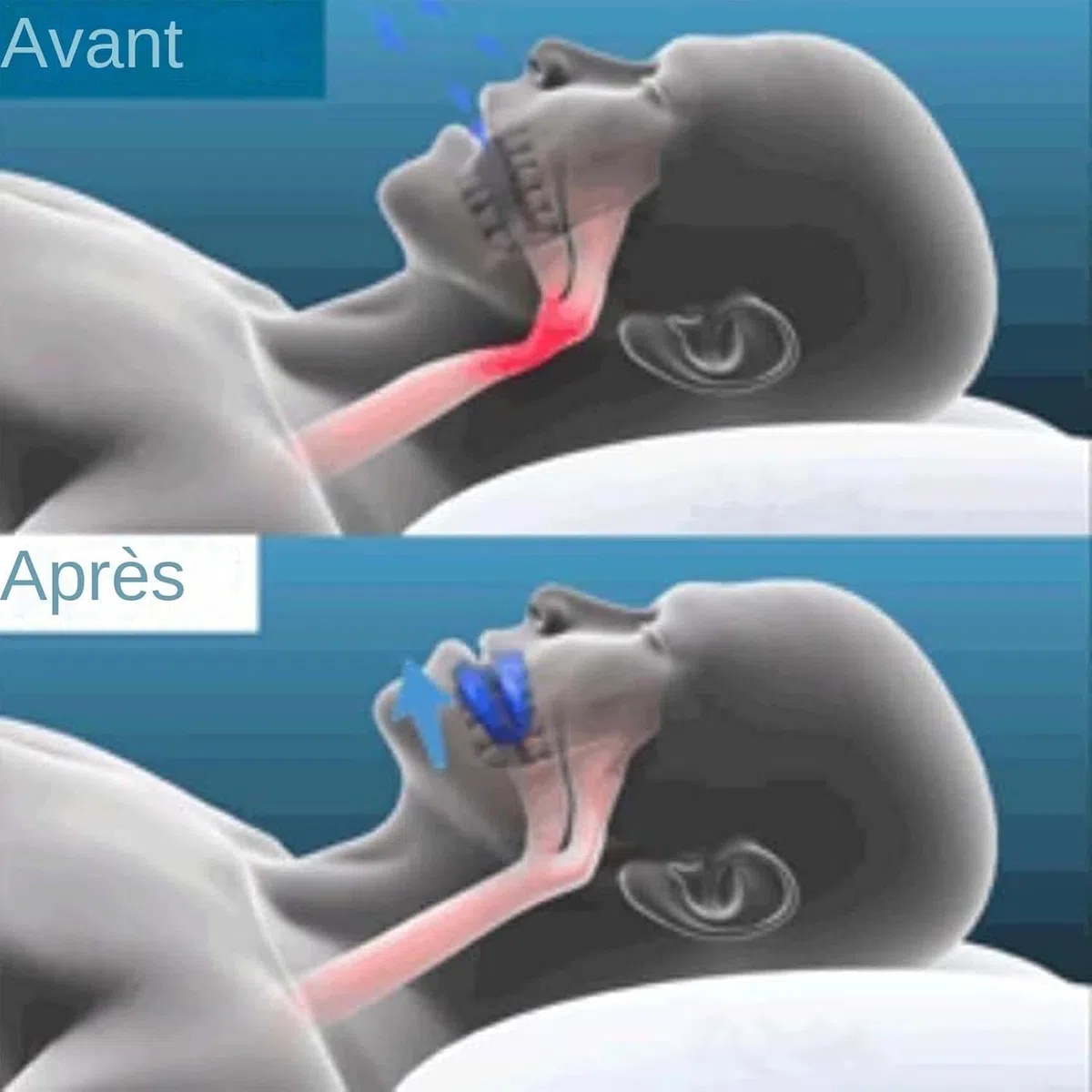 Santavya Embout Buccal anti-ronflement