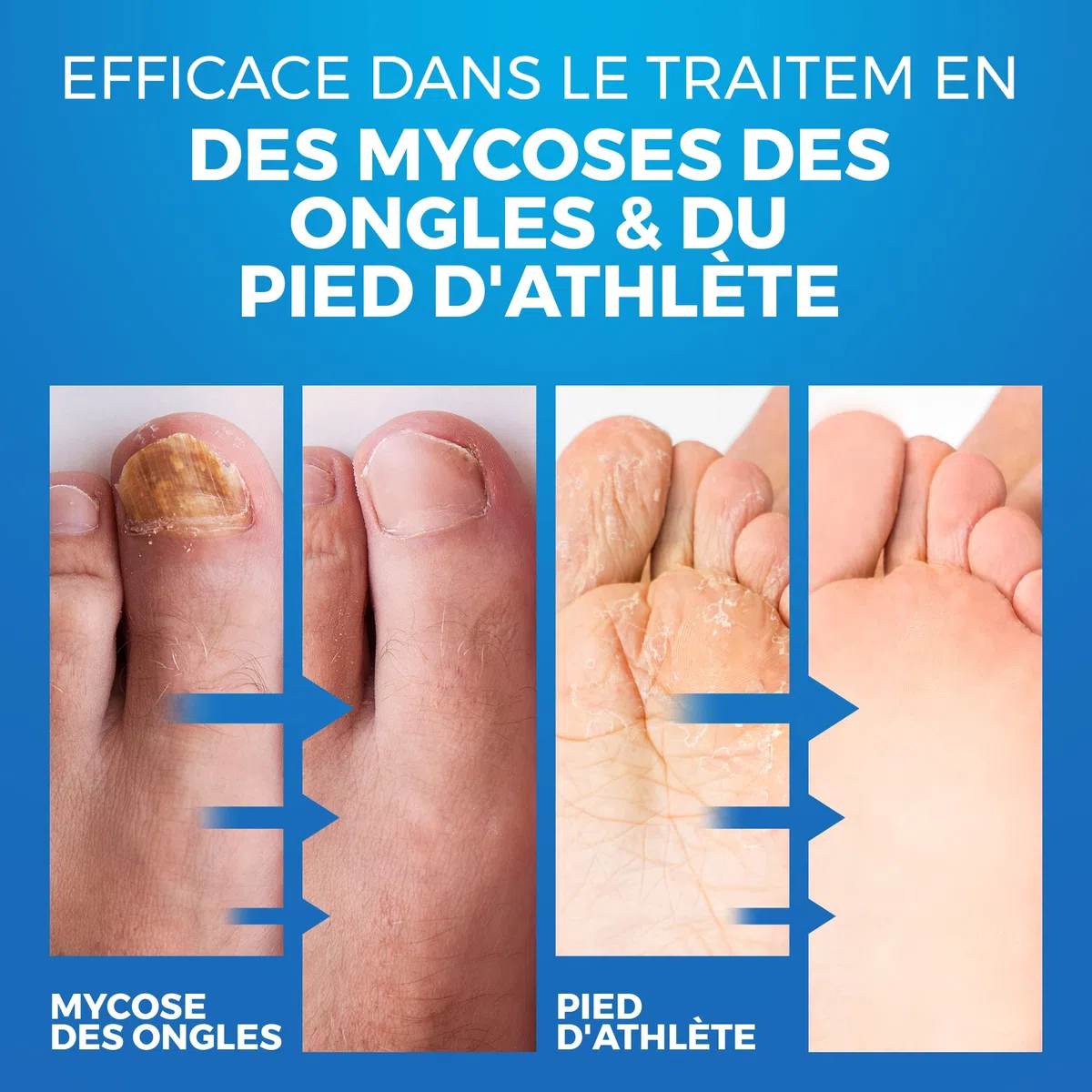 Spray Antifongique pour Chaussures - Traitement du Pied d'Athlète et des Mycoses des Ongles - Soin des Pieds Contre le - Les Champignons des Ongles et La Teigne - Désodorisant pour Chaussures - 150 ML
