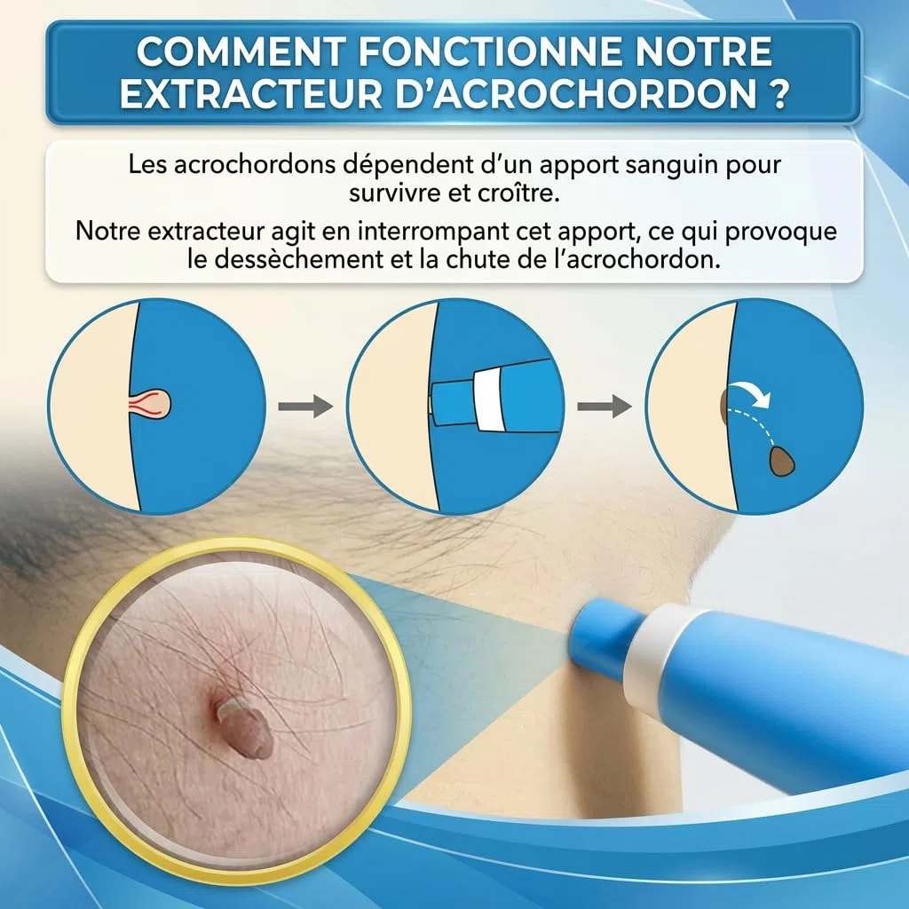 DermaSkin Pro Dermaskin Pro Acrochordon Traitement Efficace Solution Rapide Pour Éliminer Acrochordons Sans Cicatrice À La Maison (Bleu 1 ensemble)
