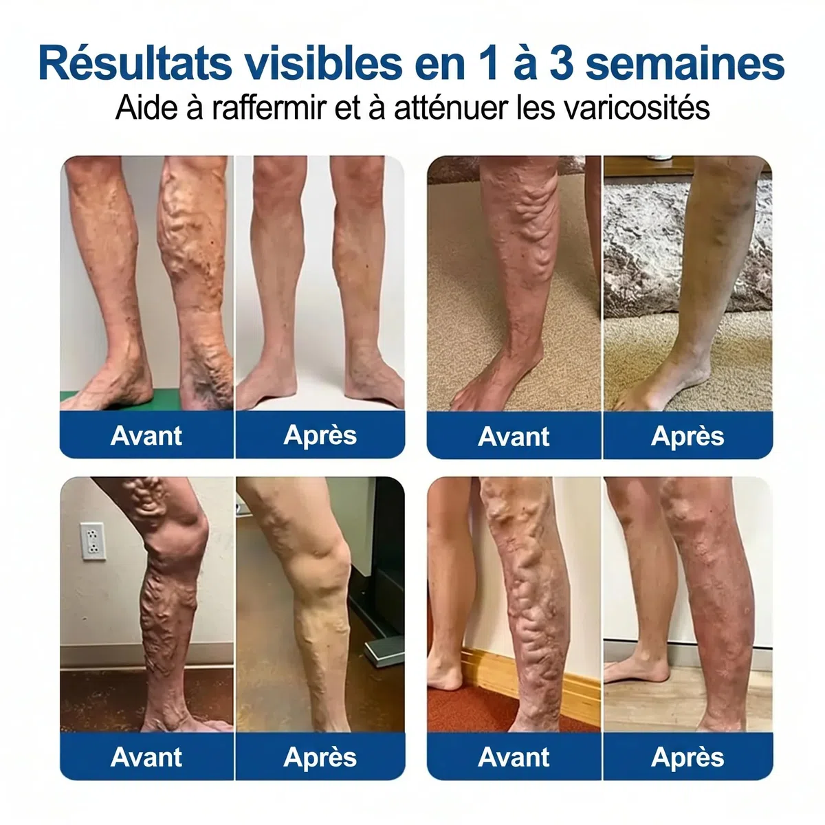 vaduma Patch Anti-Varices Patchs nourrissants pour les jambes - Soins de peau pour stimuler la mobilité - Ensemble de 12 patchs avec absorption profonde - Coussinets de traitement aux extraits